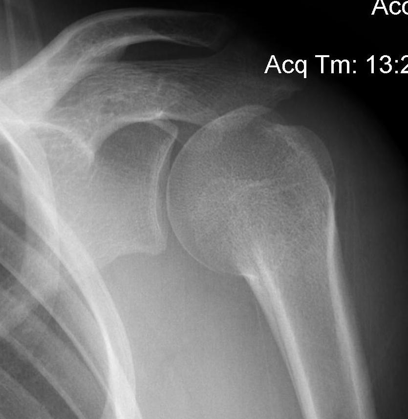 Pediatric Proximal Humeral Fracture Remodelling Post